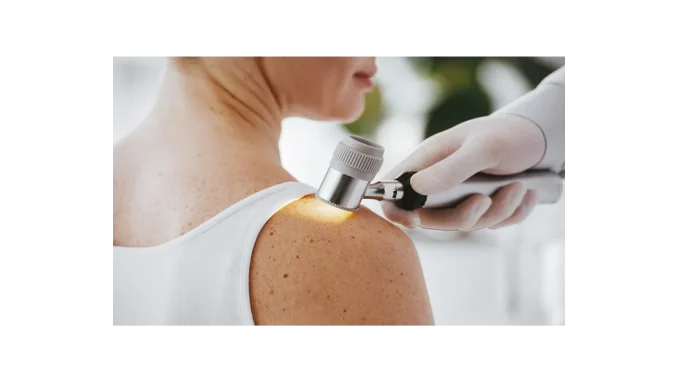 BENU upozorňuje na prevenci melanomu u Čechů